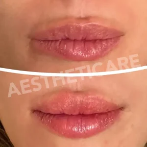 filler-labbra-napoli-aestheticare