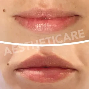 medicina-estetica-labbra-napoli-aestheticare
