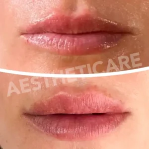 medicina-estetica-labbra-napoli-aestheticare