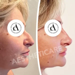 rinofiller-napoli-aestheticare