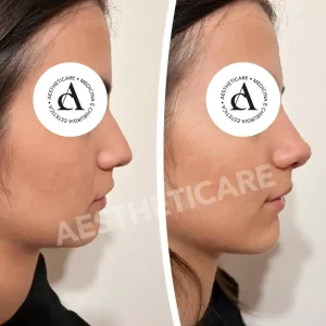 rinofiller-napoli-aestheticare