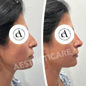 rinofiller-napoli-aestheticare