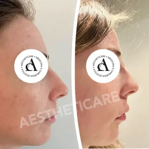 rinofiller-napoli-aestheticare